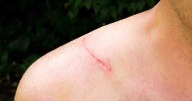scarring