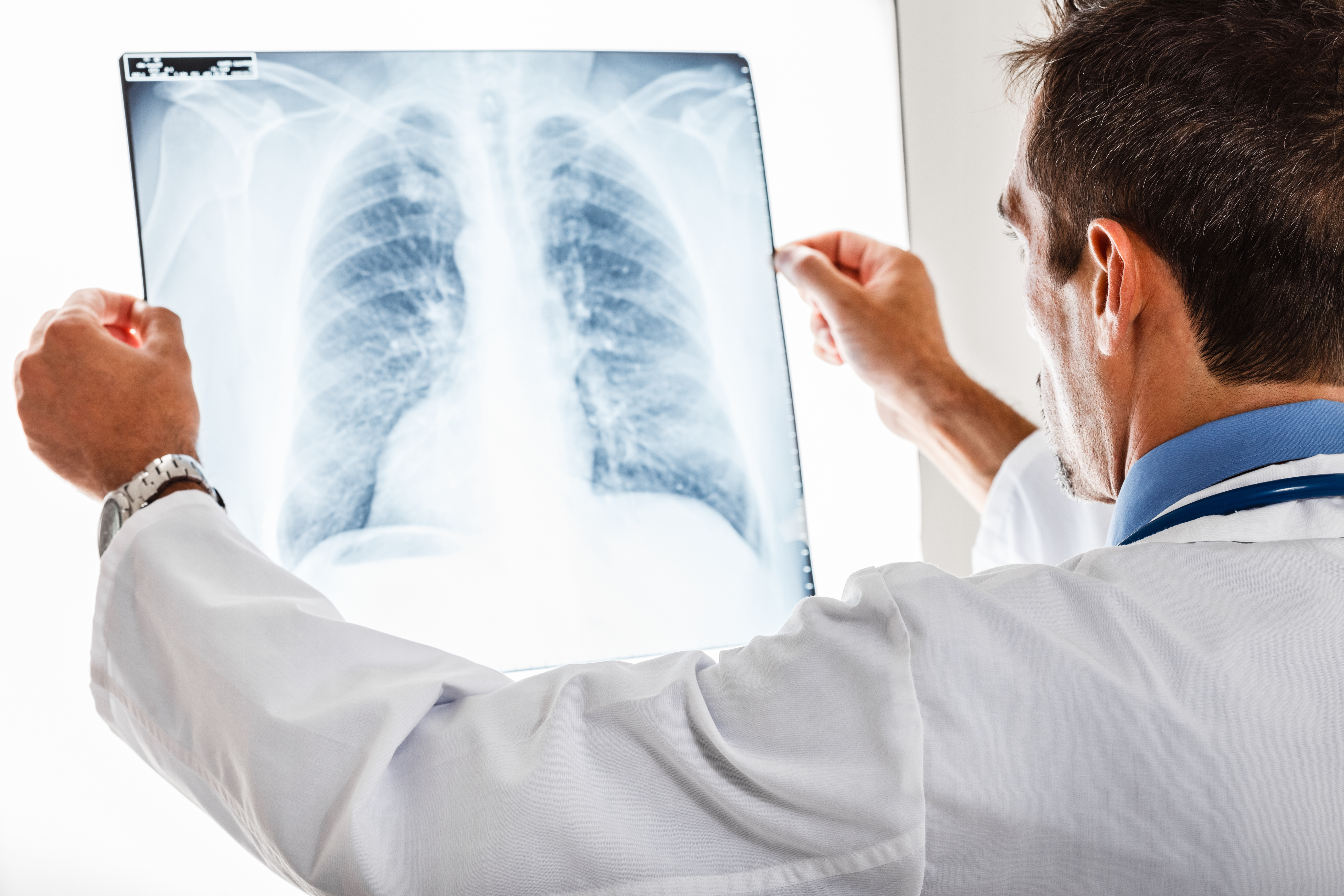 idiopathic pulmonary fibrosis diagnosis and treatment