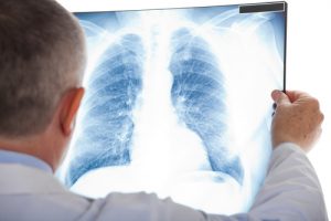 pulmonary fibrosis lung transplant