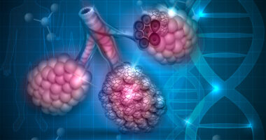 MUC5B risk factor