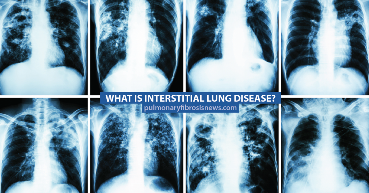 What Is Interstitial Lung Disease? - Pulmonary Fibrosis News