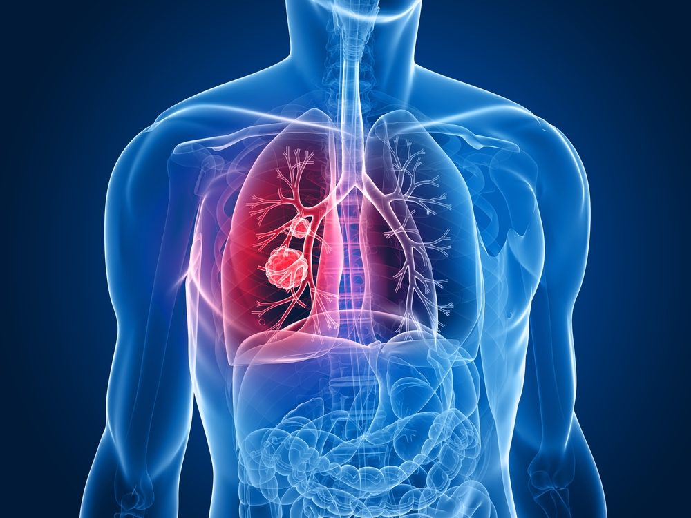 Pulmonary Fibrosis Patients Lung Cancer Might Respond To Ofev Study Reports