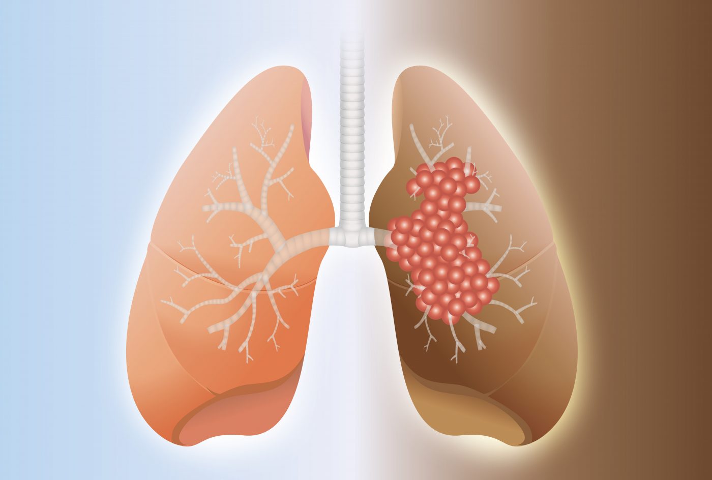 Lung fibrosis