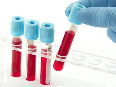 inflammation and oxidative stress