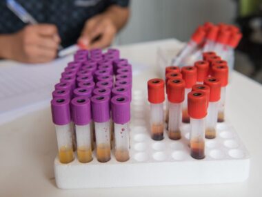 Osteopontin Protein Linked to Exacerbations