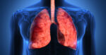 pulmonary rehabilitation | Pulmonary Fibrosis News | A stock photo showing a graphic rendering of a person's lungs.