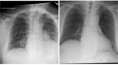 bilateral lung transplant | Pulmonary Fibrosis News | A two-photo collage of X-rays of Sam's lungs. The first X-ray shows his damaged lungs the day before he had lung transplant. The second shows his post-transplant lungs, which look much healthier