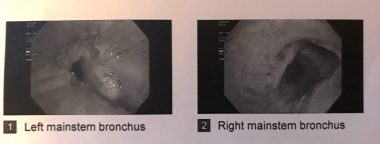 Two bronchoscopy images show a man's left and right mainstream bronchi. The left one is significantly narrower than the one on the right. 